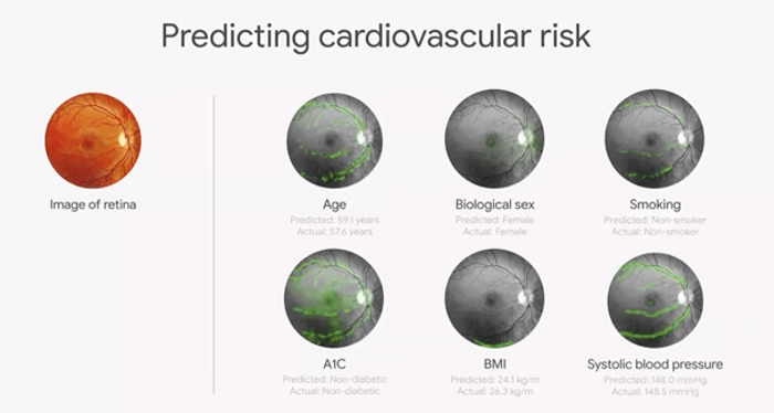AI predicting health condition through retinal scans